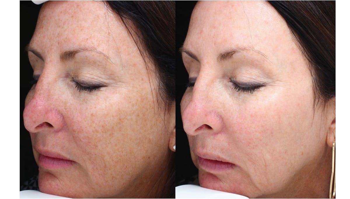 Halo Laser Resurfacing Before & After Gallery - Patient 58178647 - Image 1