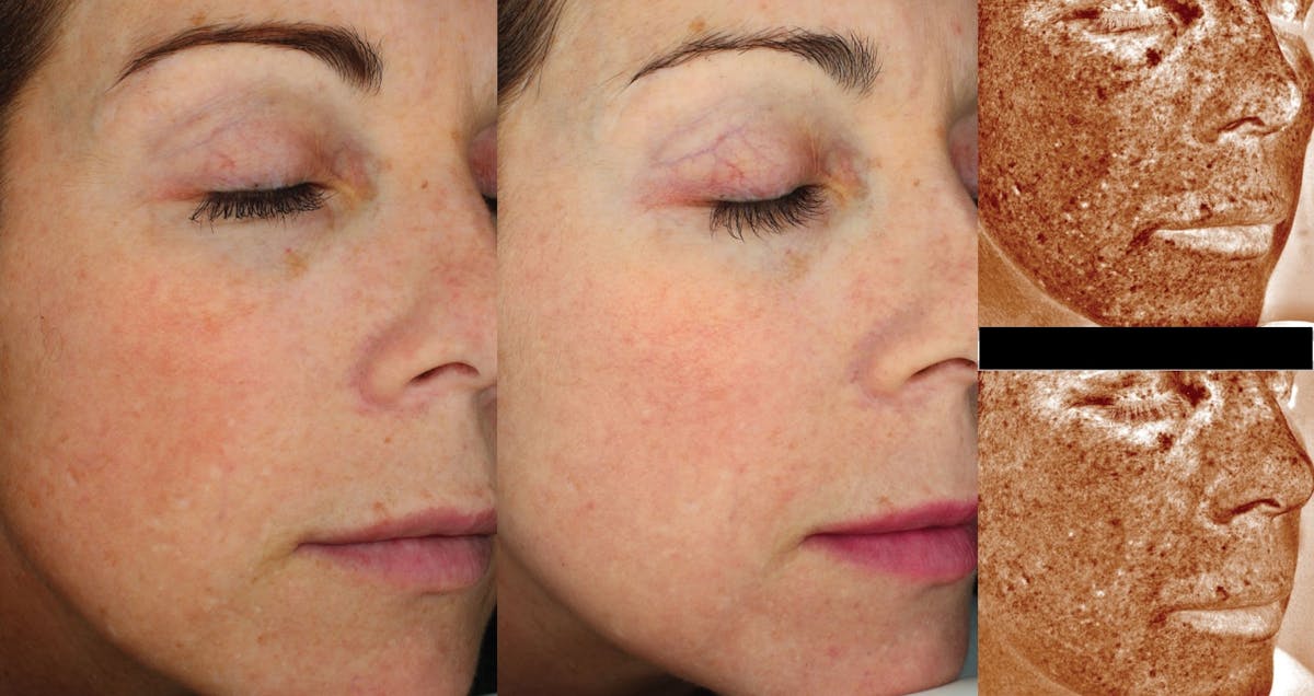 Halo Laser Resurfacing Before & After Gallery - Patient 58178648 - Image 1