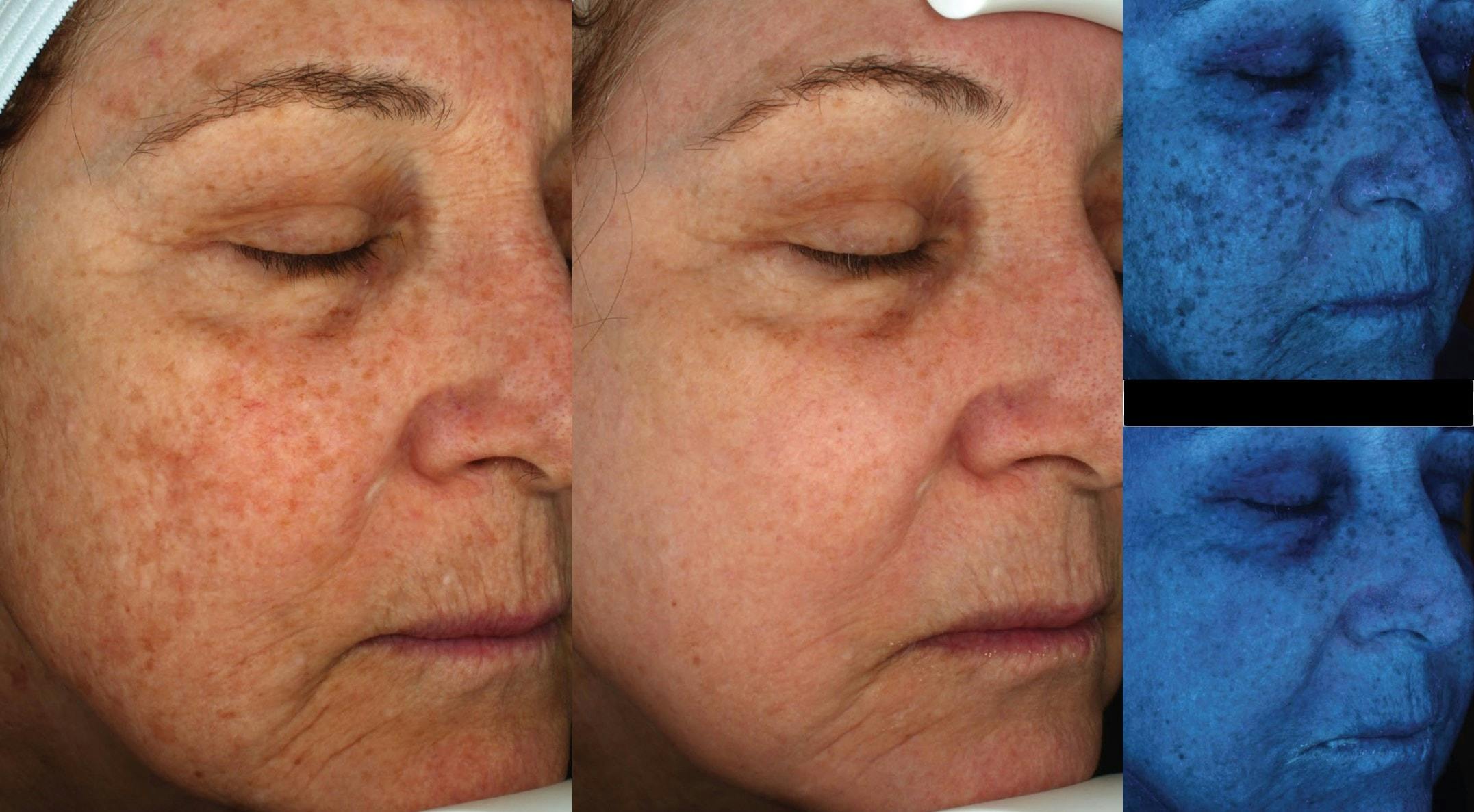 Halo Laser Resurfacing Before & After Gallery - Patient 58178649 - Image 1