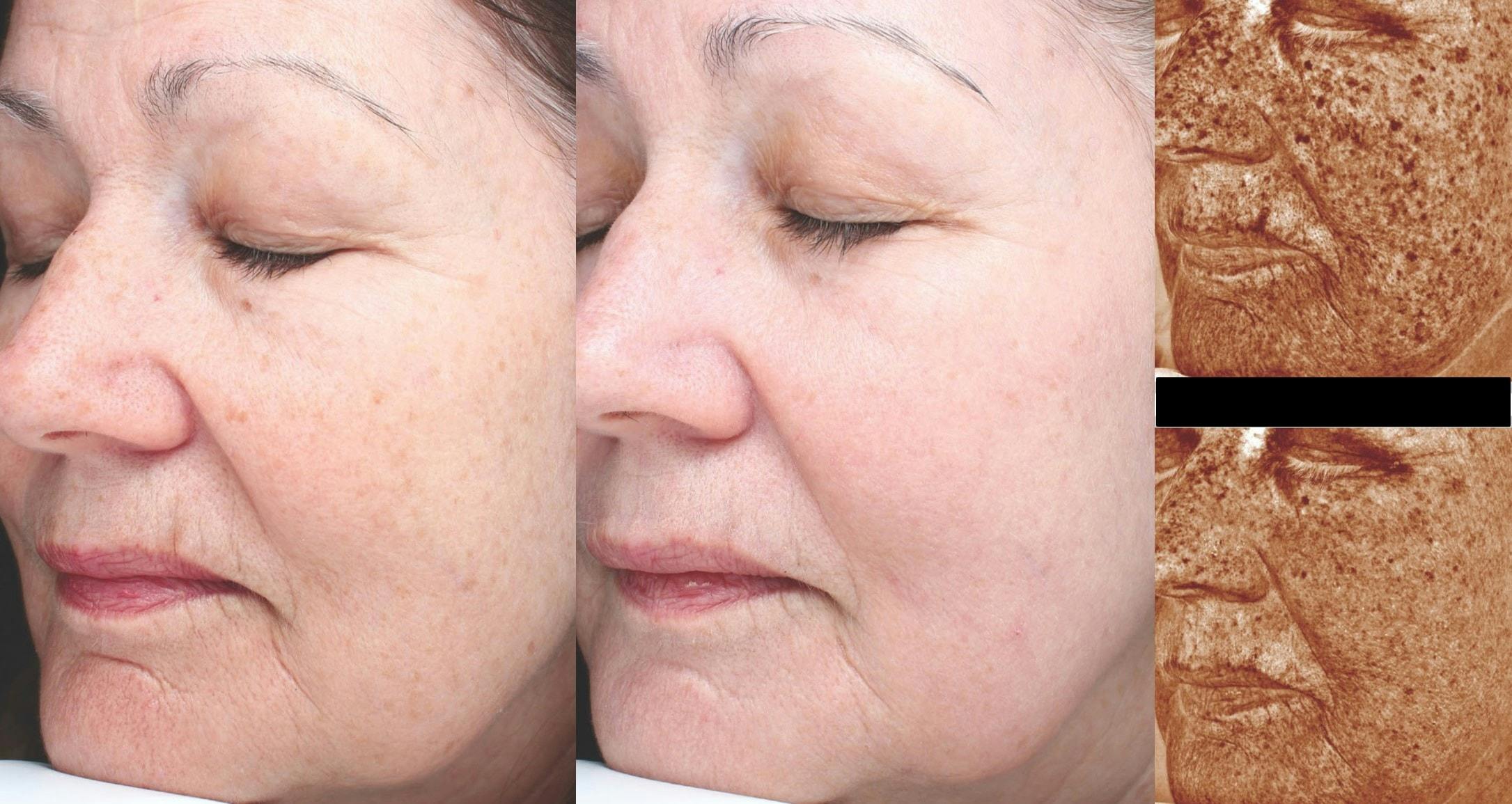 Halo Laser Resurfacing Before & After Gallery - Patient 58178650 - Image 1