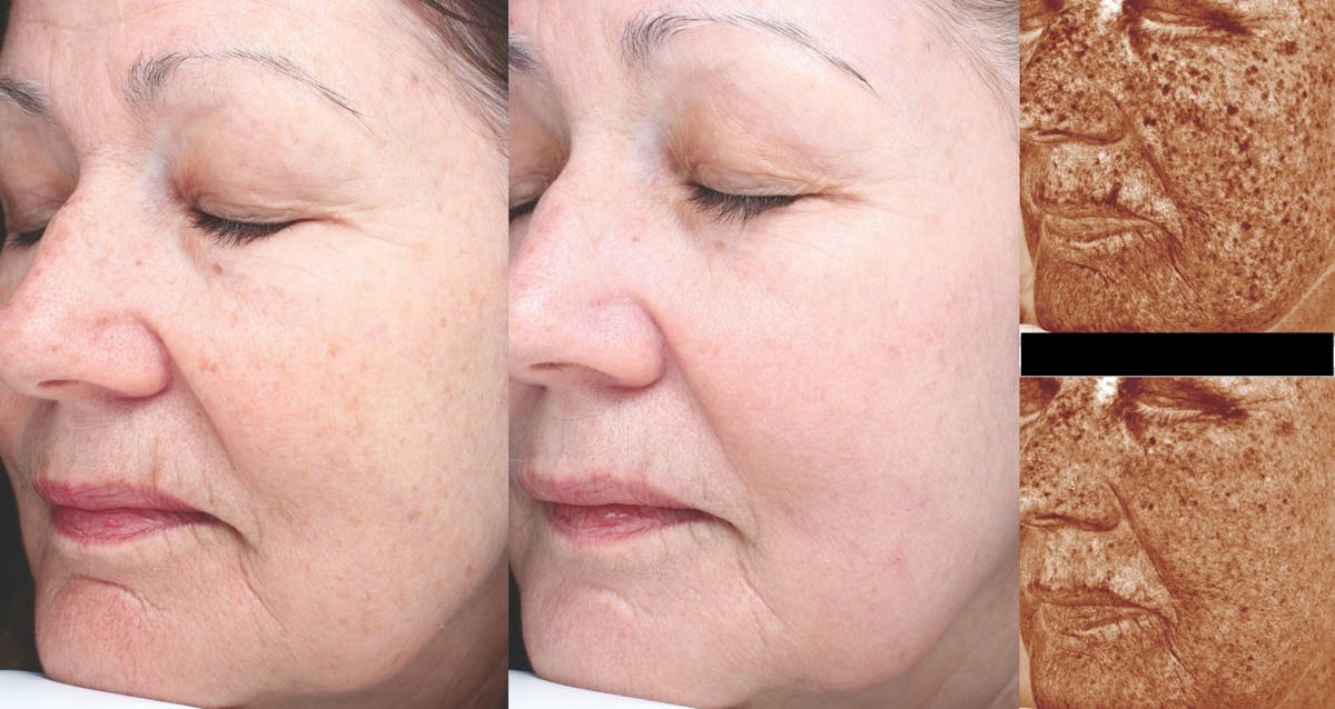 Halo Laser Resurfacing Before & After Gallery - Patient 58178650 - Image 1