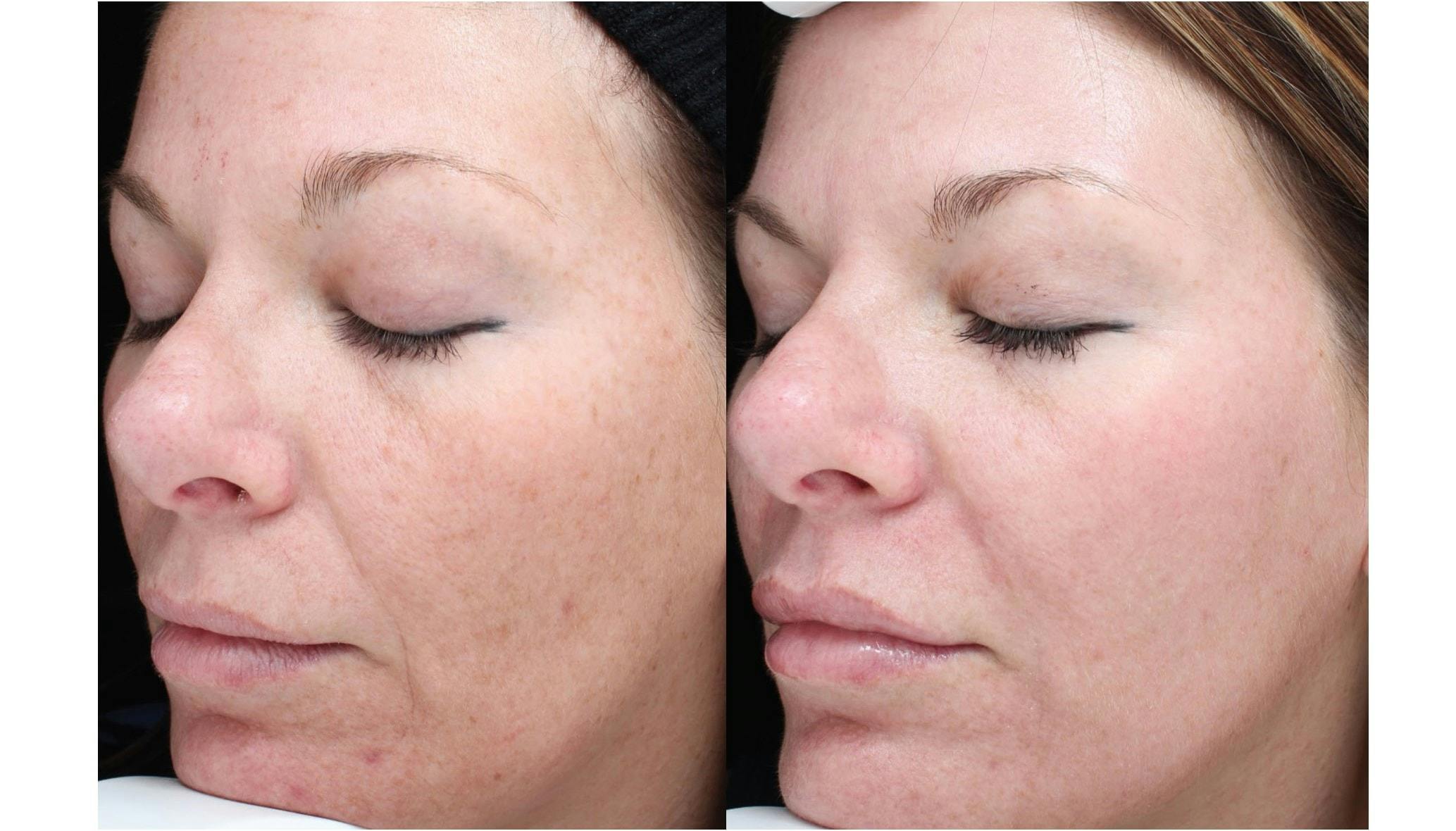 Halo Laser Resurfacing Before & After Gallery - Patient 58178651 - Image 1