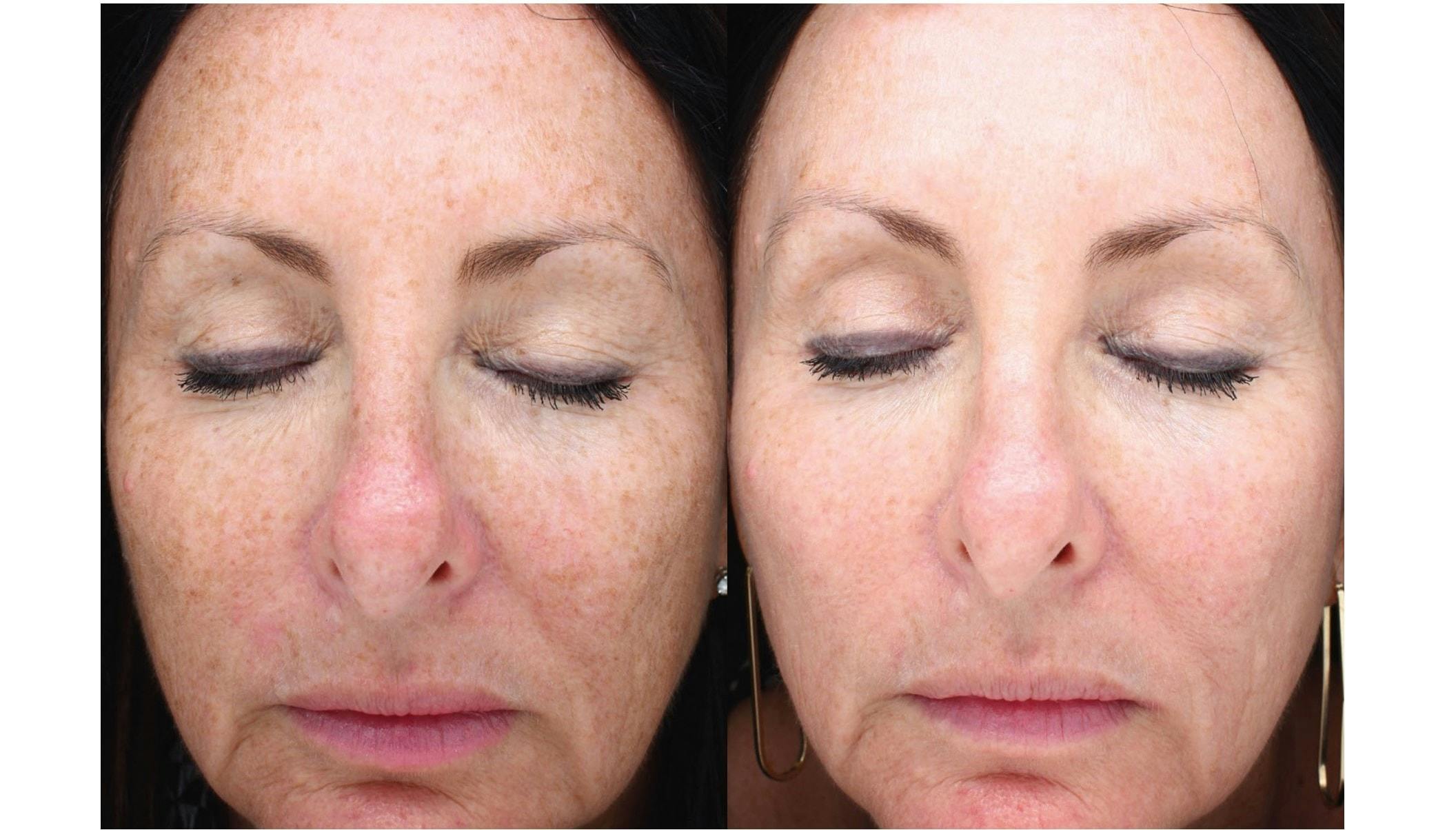 Halo Laser Resurfacing Before & After Gallery - Patient 58178647 - Image 2