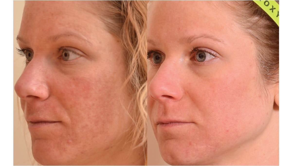 Halo Laser Resurfacing Before & After Gallery - Patient 58178653 - Image 1