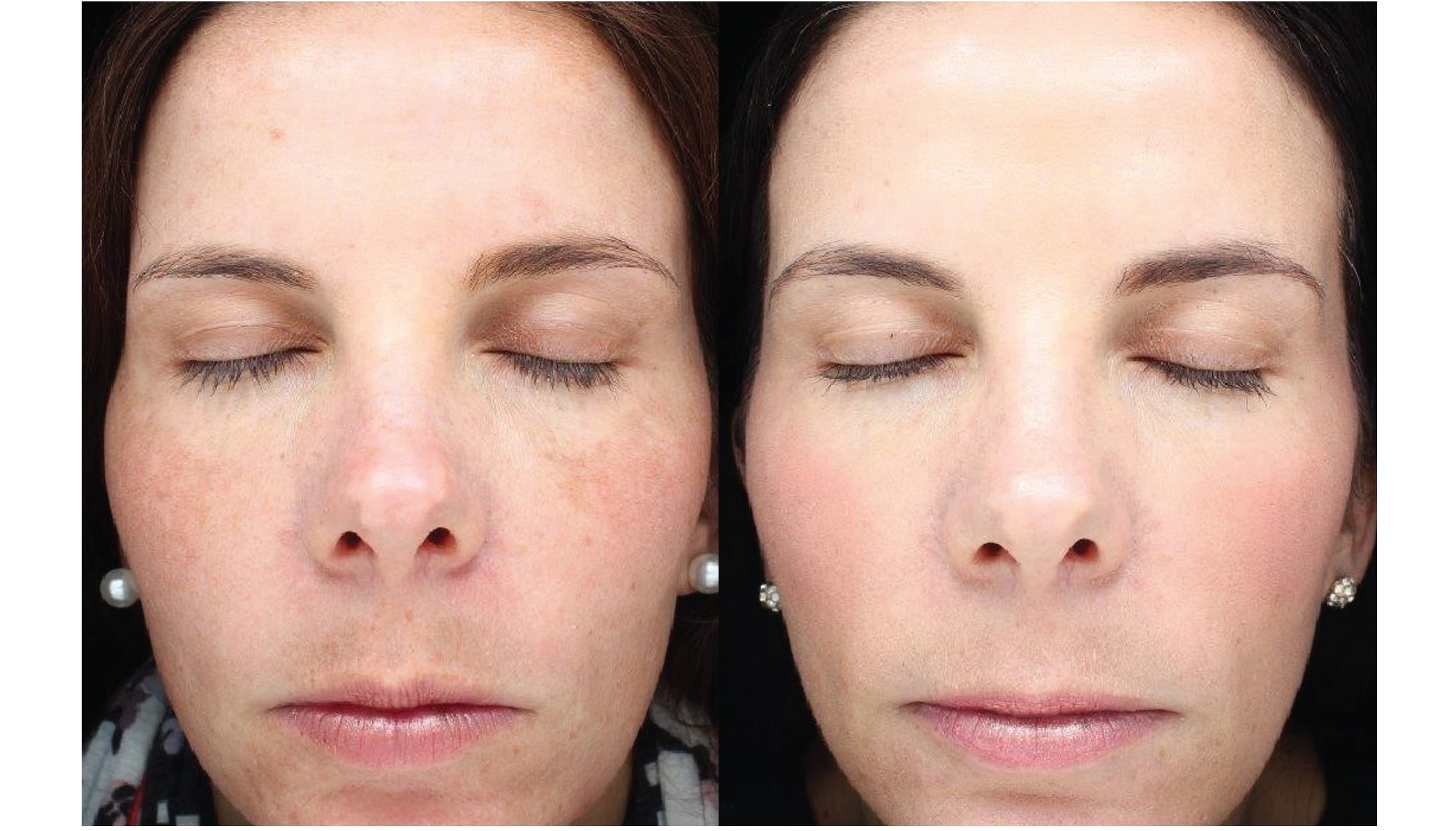 Halo Laser Resurfacing Before & After Photos Face Forward Medical