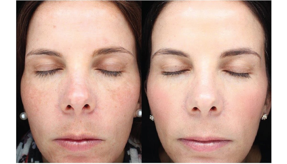 Halo Laser Resurfacing Before & After Gallery - Patient 58178654 - Image 1