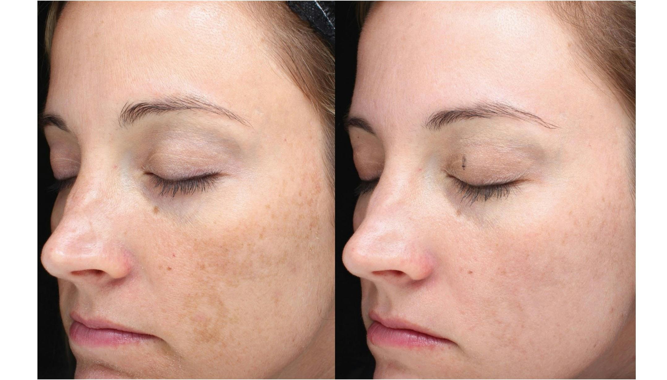 Halo Laser Resurfacing Before & After Gallery - Patient 58178655 - Image 1
