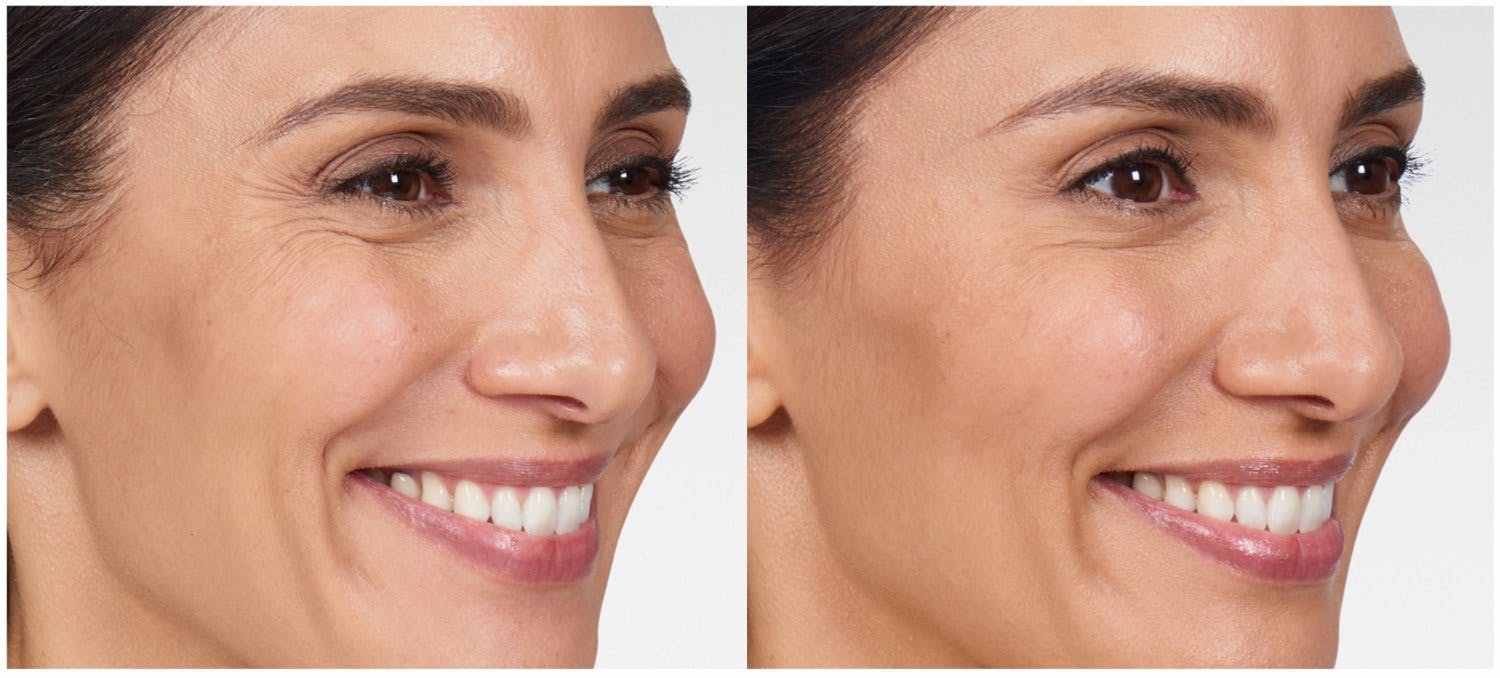 BOTOX in Lexington, MA Before & After Photos