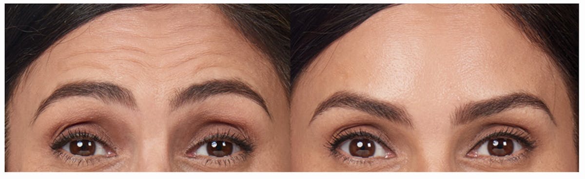 Botox & Dysport Before & After Gallery - Patient 58178941 - Image 2