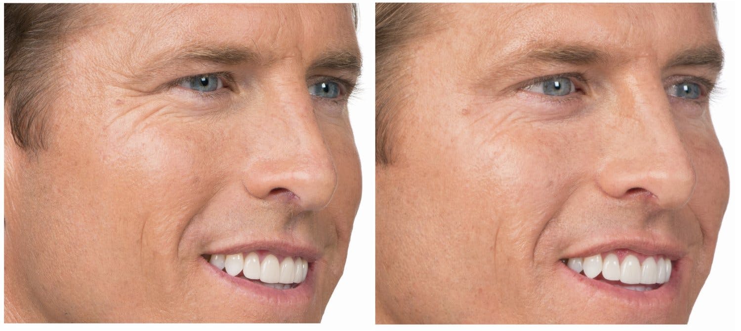 Botox & Dysport Before & After Gallery - Patient 58178943 - Image 1