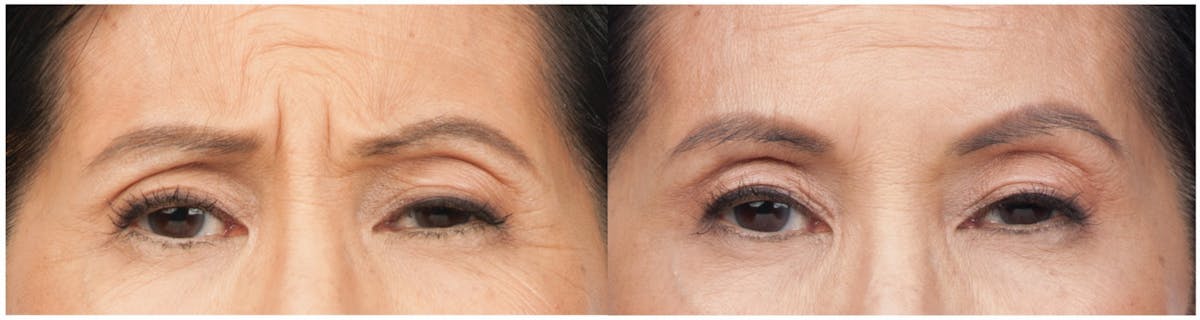 Botox & Dysport Before & After Gallery - Patient 58178942 - Image 2
