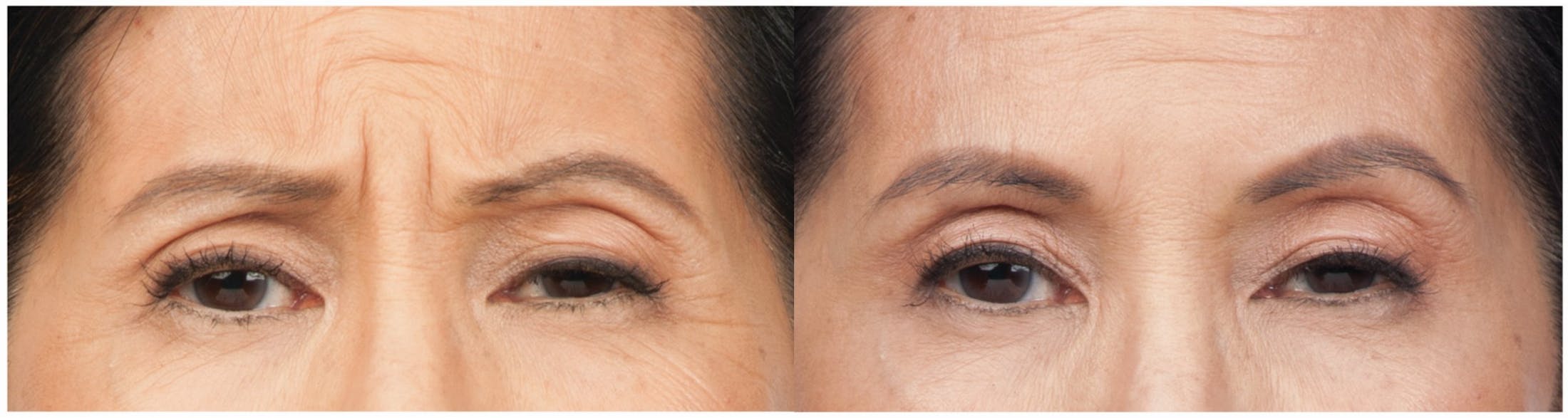 Botox & Dysport Before & After Gallery - Patient 58178942 - Image 2