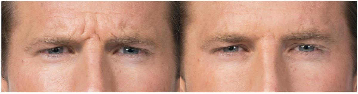Botox & Dysport Before & After Gallery - Patient 58178943 - Image 2