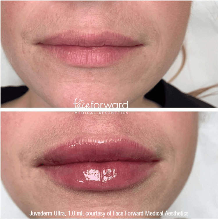 Dermal Fillers