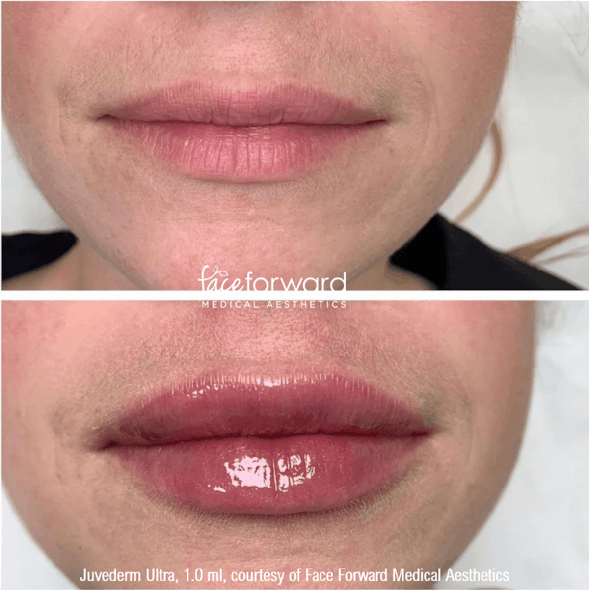 Dermal Filler Before & After Gallery - Patient 58179081 - Image 1