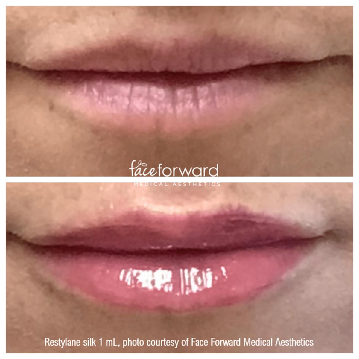 Dermal Filler Before & After Gallery - Patient 58179082 - Image 1