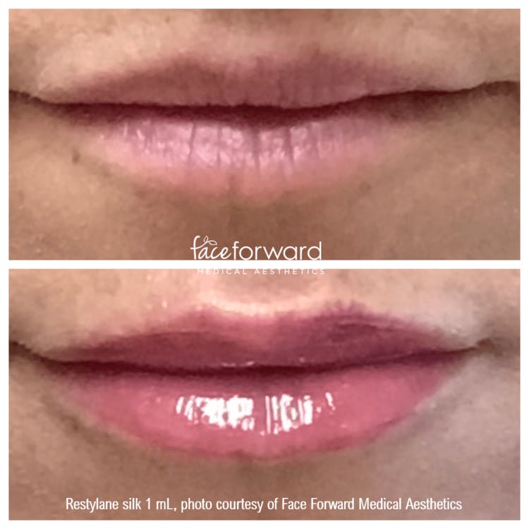 Dermal Filler Before & After Gallery - Patient 58179082 - Image 1