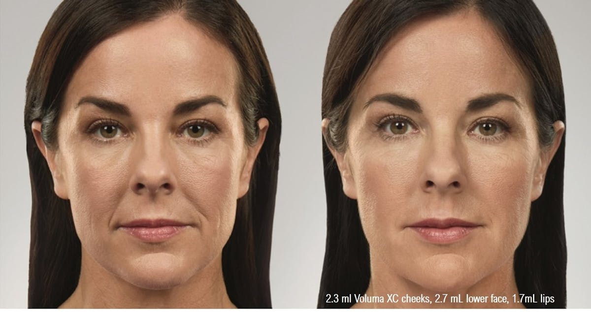 Dermal Filler Before & After Gallery - Patient 58179084 - Image 1
