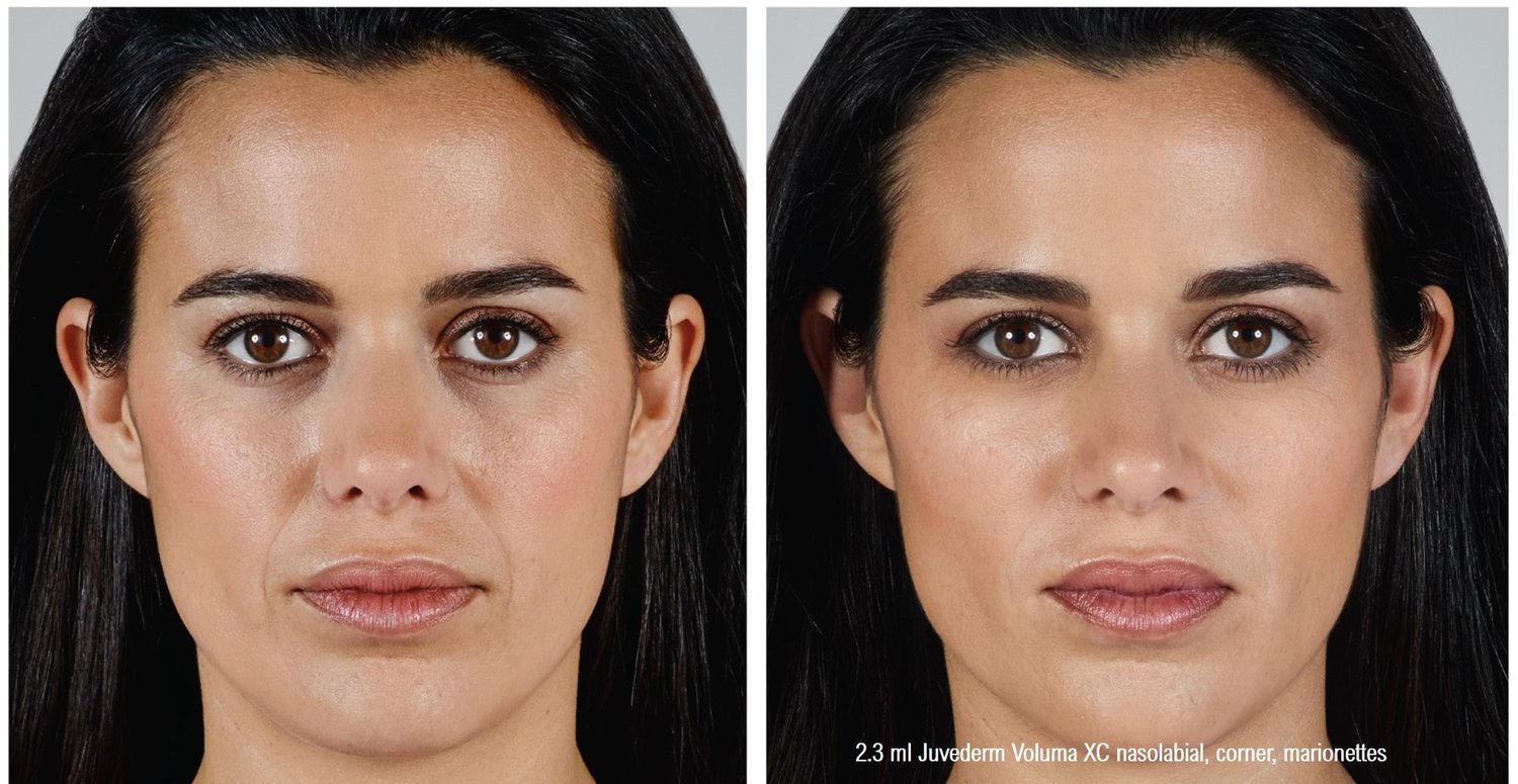Dermal Filler Before & After Photos Face Forward Medical Aesthetics