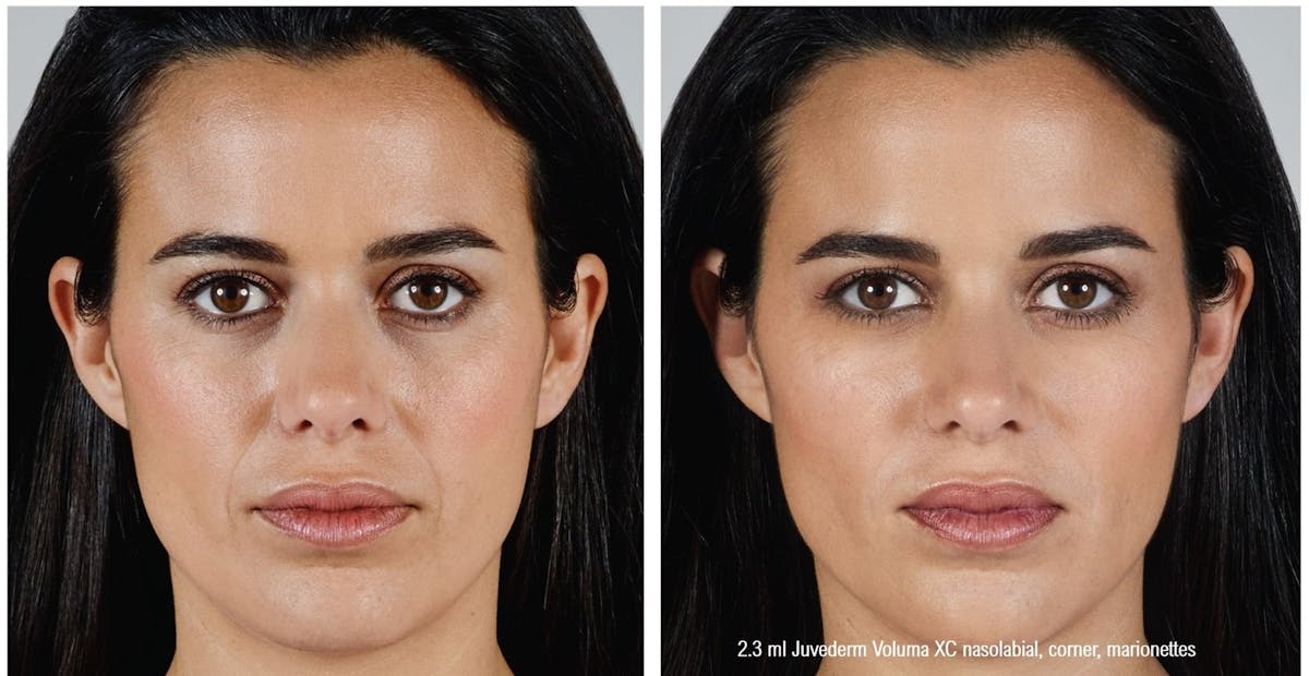 Dermal Filler Before & After Gallery - Patient 58179085 - Image 1