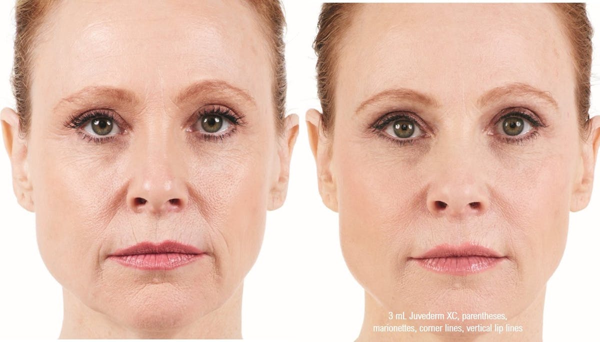 Dermal Filler Before & After Gallery - Patient 58179086 - Image 1