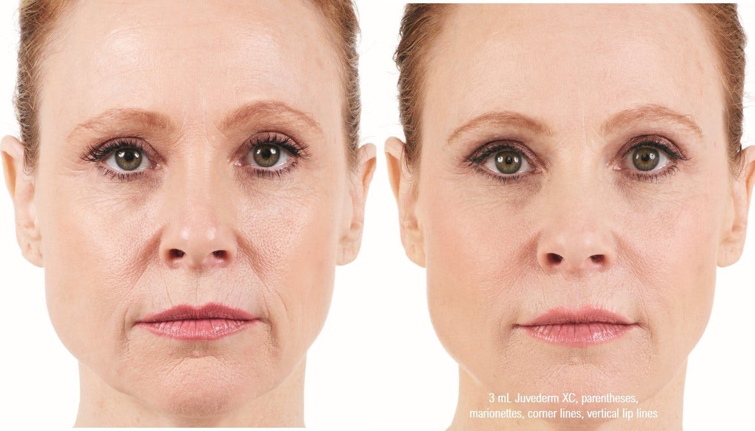 Dermal Filler Before & After Gallery - Patient 58179086 - Image 1