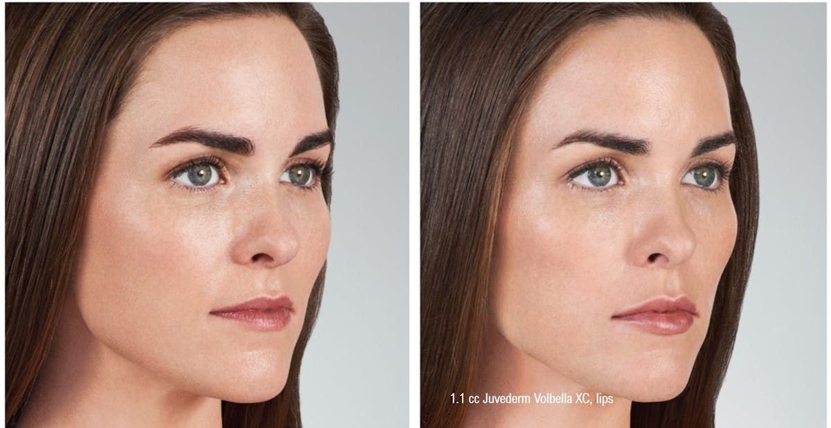 Dermal Filler Before & After Gallery - Patient 58179087 - Image 1