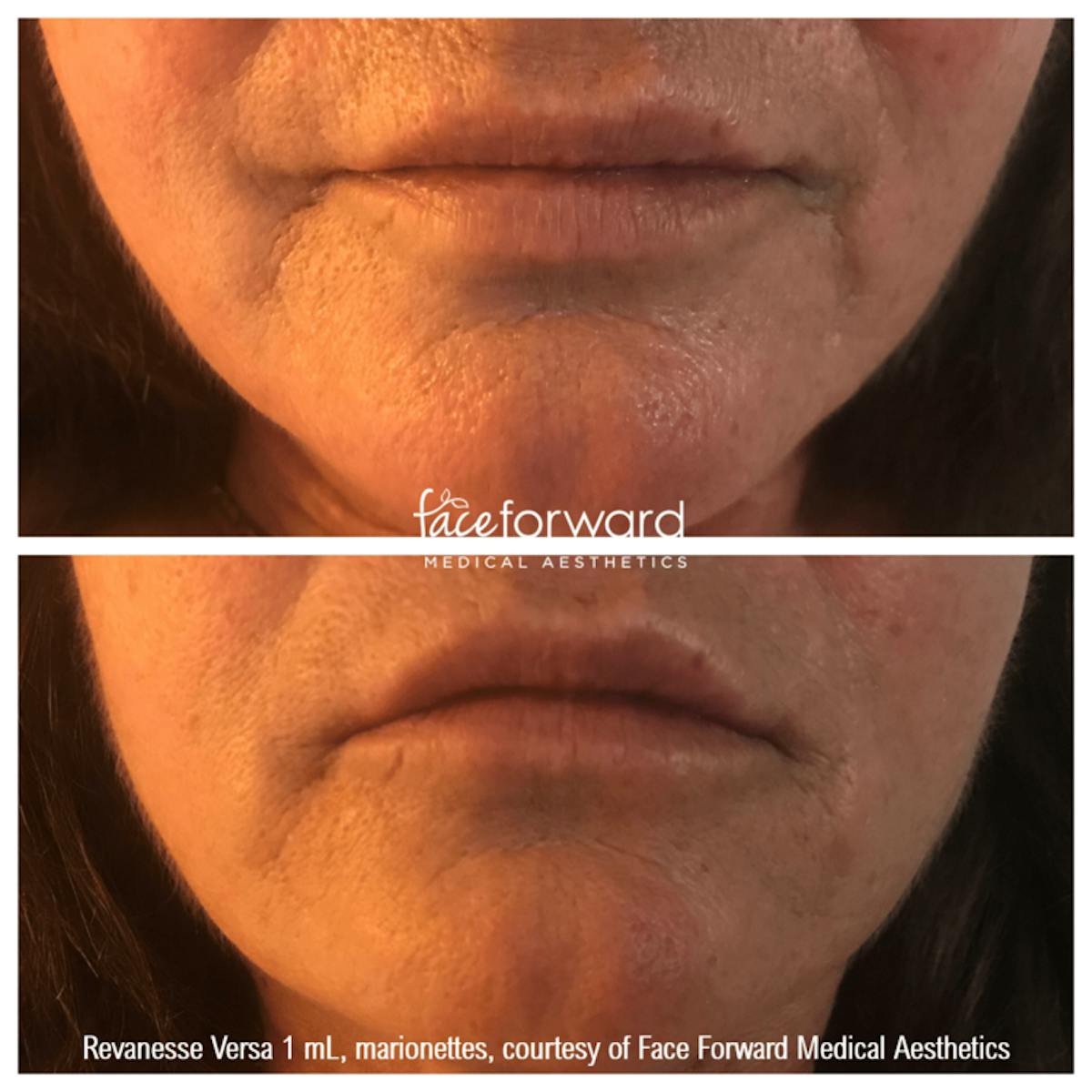 Dermal Filler Before & After Gallery - Patient 58179088 - Image 1