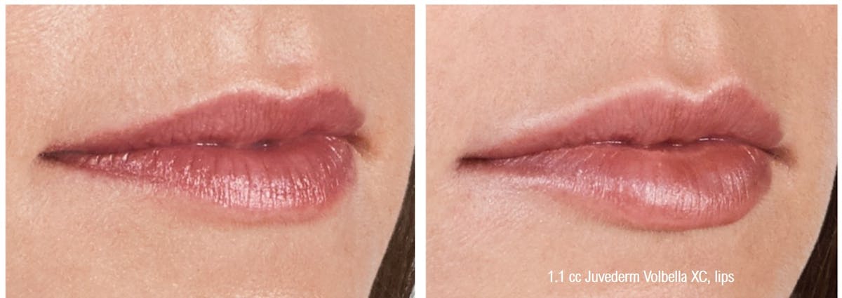 Dermal Filler Before & After Gallery - Patient 58179089 - Image 1