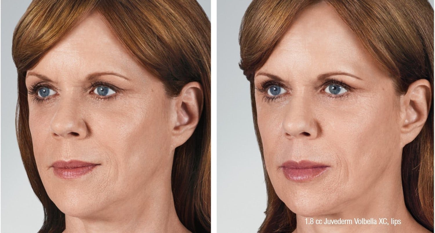 Dermal Filler Before & After Gallery - Patient 58179090 - Image 1
