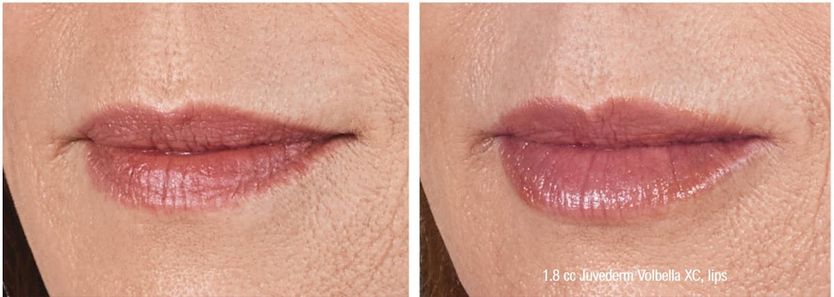 Dermal Filler Before & After Gallery - Patient 58179090 - Image 2