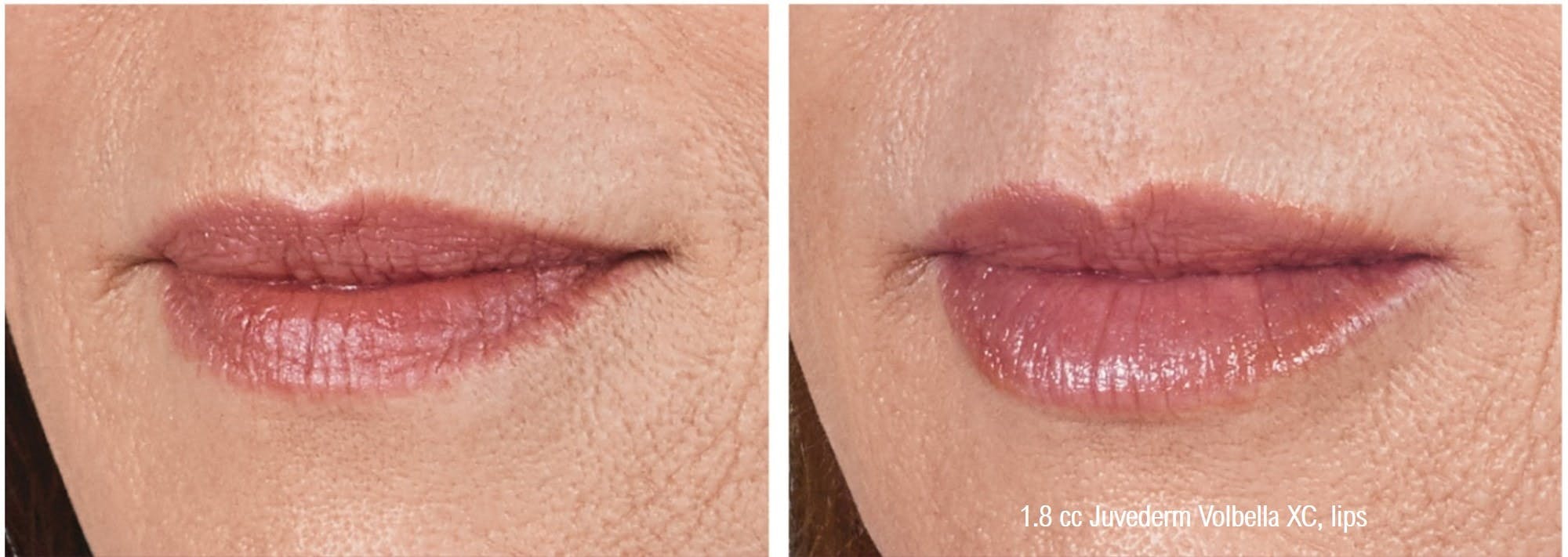 Dermal Filler Before & After Gallery - Patient 58179090 - Image 2