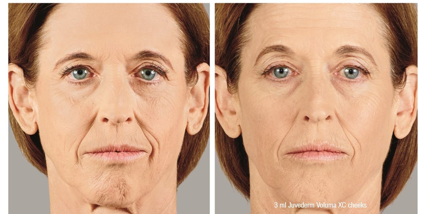 Dermal Filler Before & After Photos Face Forward Medical Aesthetics