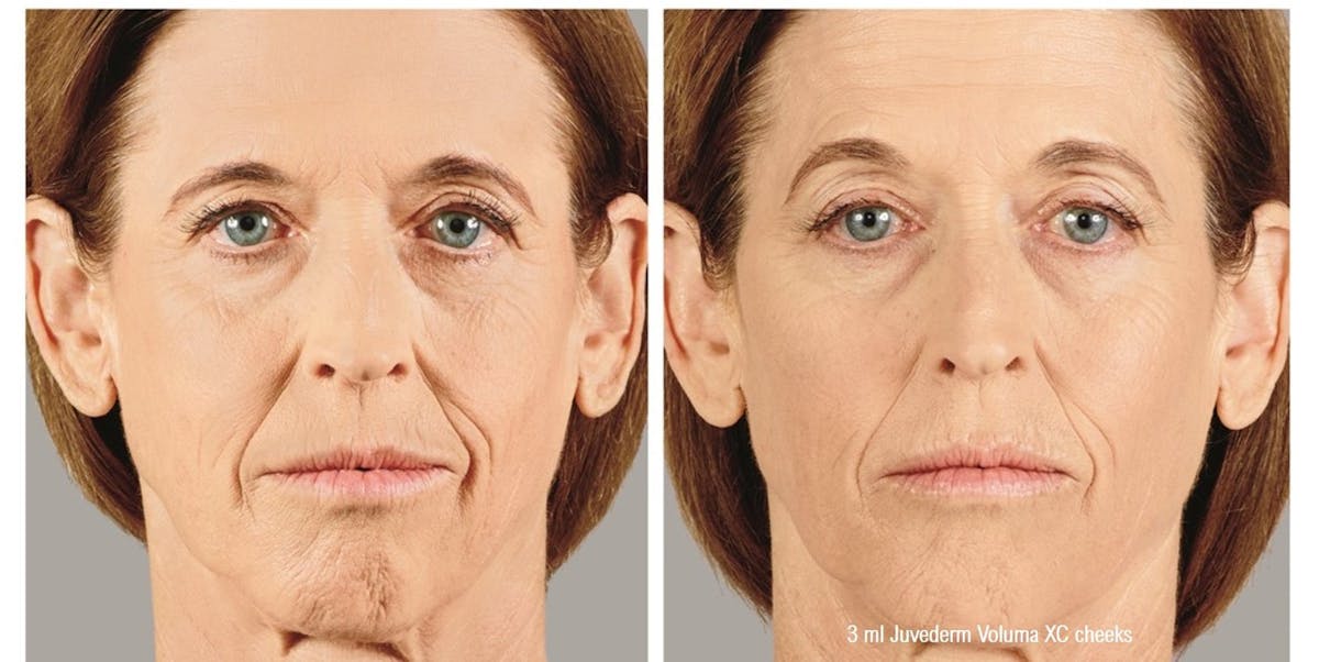 Dermal Filler Before & After Gallery - Patient 58179091 - Image 1