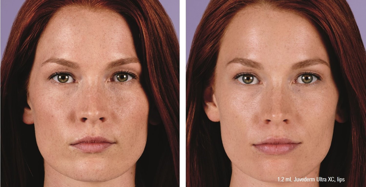 Dermal Filler Before & After Photos Face Forward Medical Aesthetics