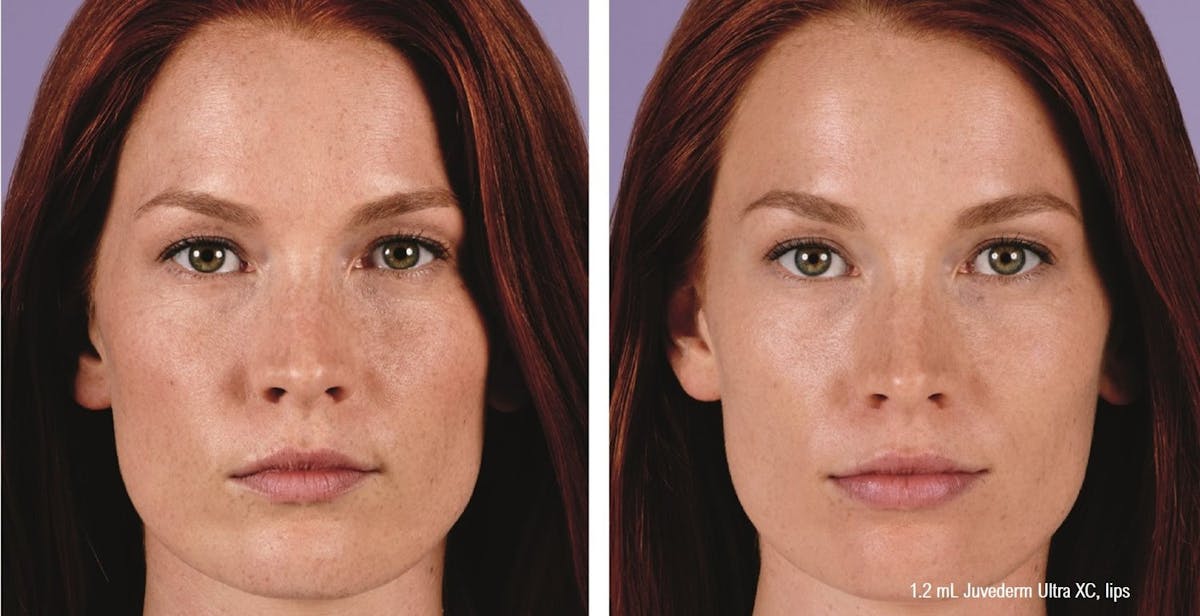 Dermal Filler Before & After Gallery - Patient 58179092 - Image 1
