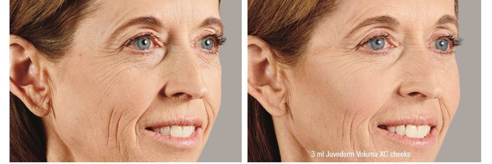 Halo Laser Resurfacing Before & After Gallery - Patient 60836722 - Image 1