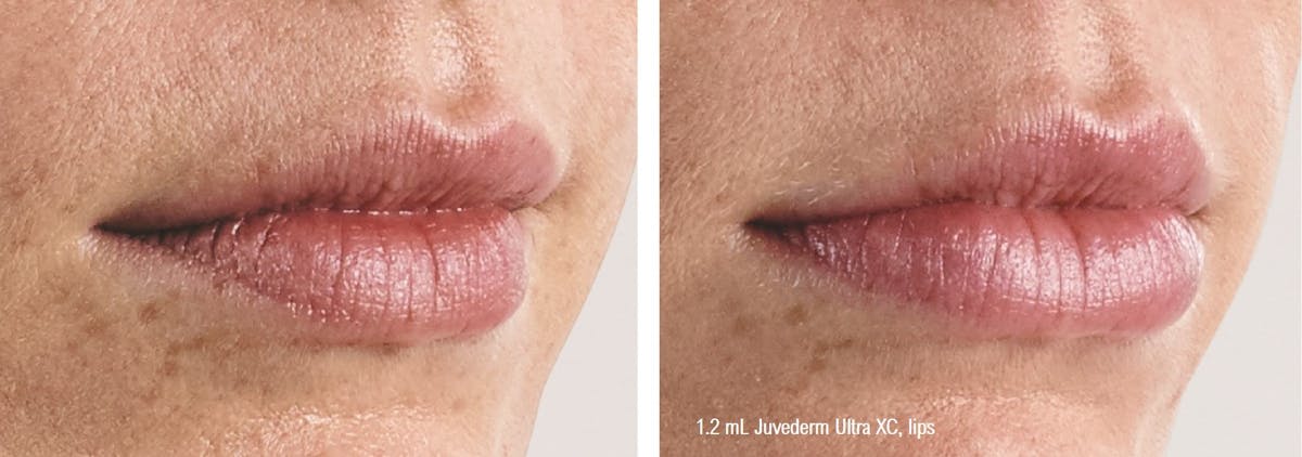 Dermal Filler Before & After Gallery - Patient 58179093 - Image 1
