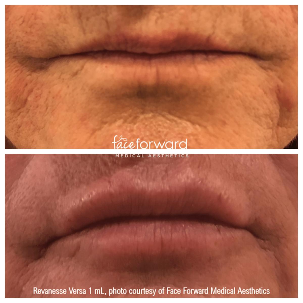 Dermal Filler Before & After Gallery - Patient 58179094 - Image 1