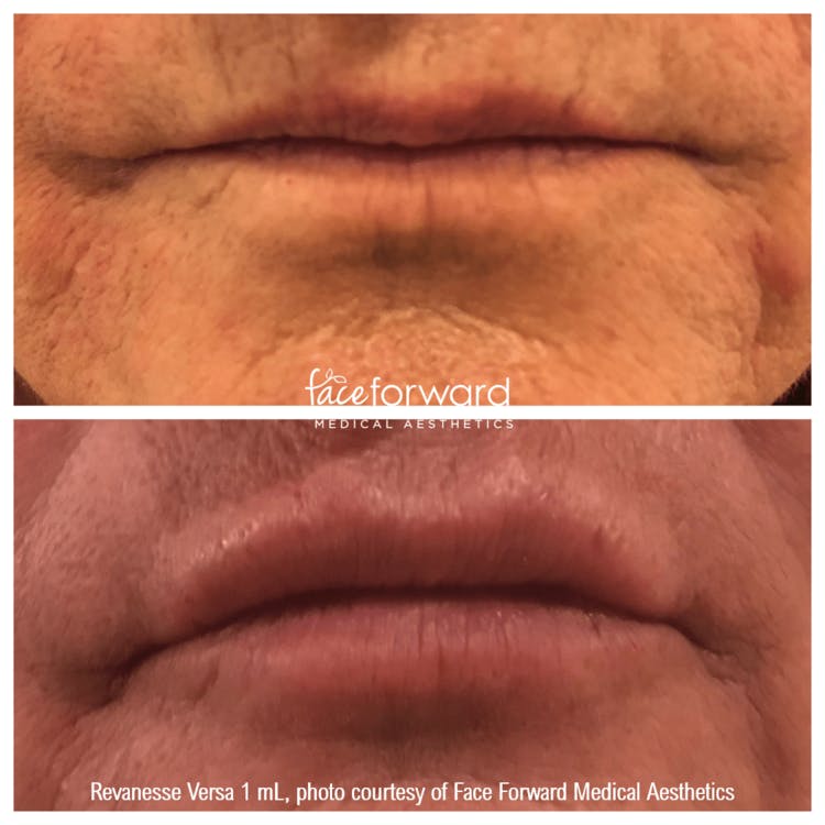 Dermal Filler Before & After Gallery - Patient 58179094 - Image 1