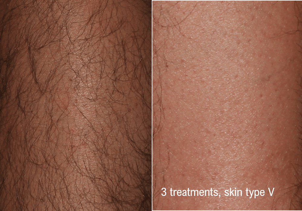 Laser Hair Removal in Lexington, MA, Before & After Photos