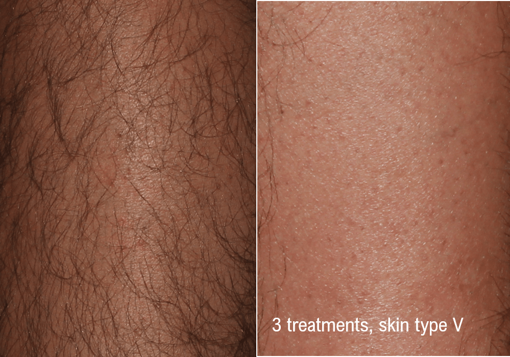 Hair Removal (Forever Bare BBL) Before & After Gallery - Patient 58179103 - Image 1