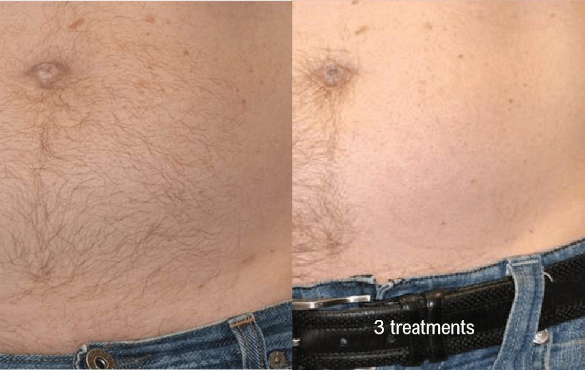 Hair Removal (Forever Bare BBL) Before & After Gallery - Patient 58179104 - Image 1