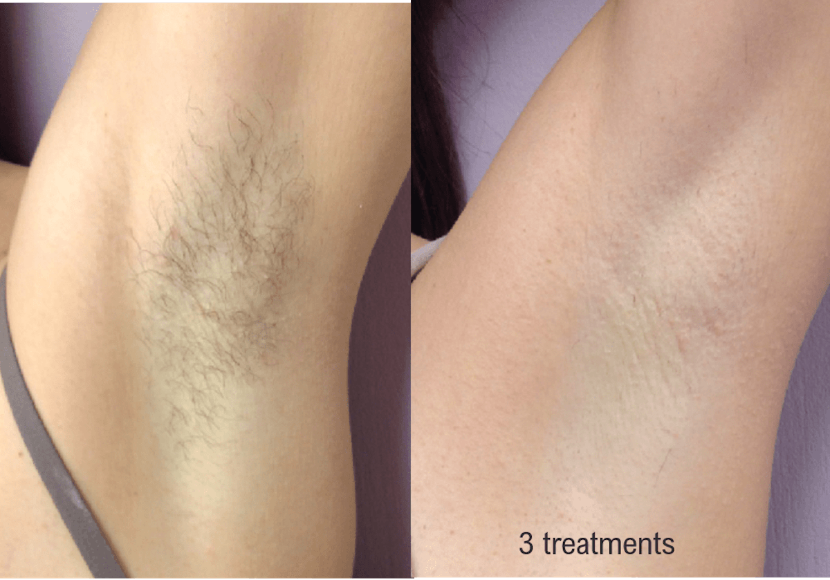 Hair Removal (Forever Bare BBL) Before & After Gallery - Patient 58179105 - Image 1