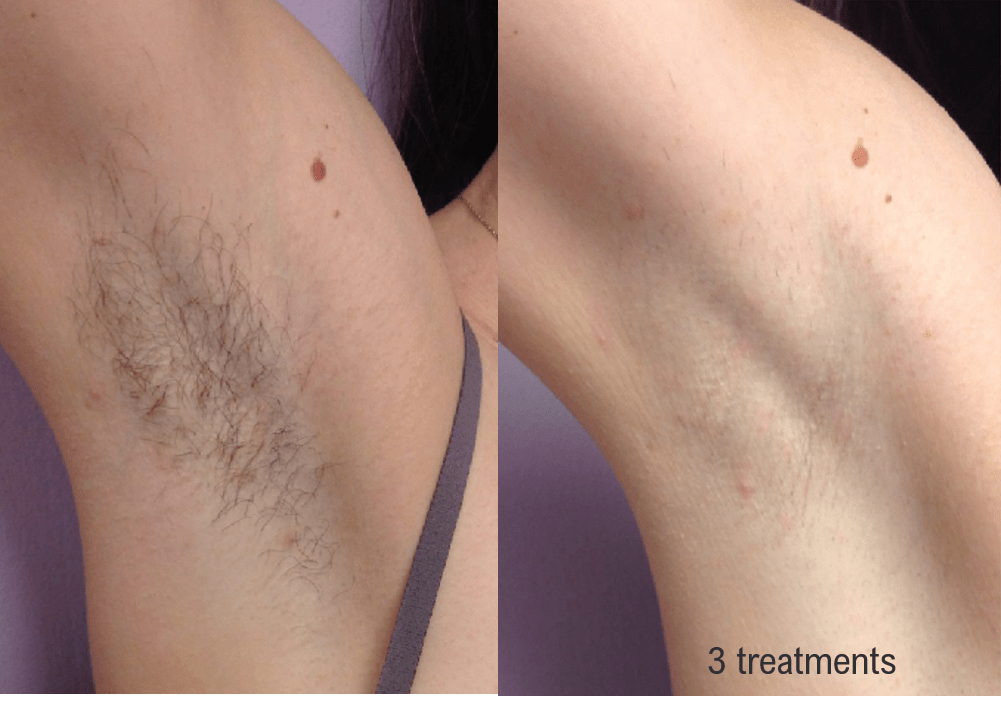 Laser Hair Removal in Lexington, MA, Before & After Photos