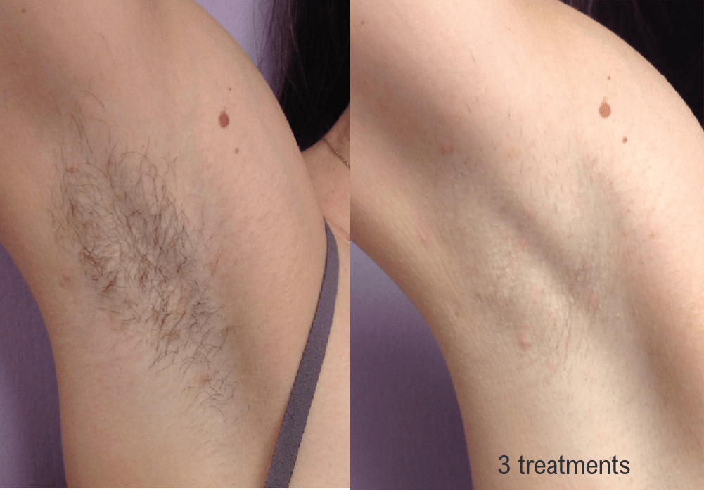 Hair Removal (Forever Bare BBL) Before & After Gallery - Patient 58179106 - Image 1
