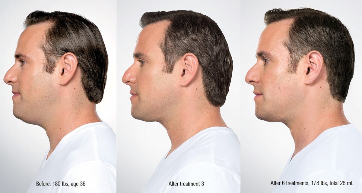 Kybella Before & After Gallery - Patient 58178643 - Image 1