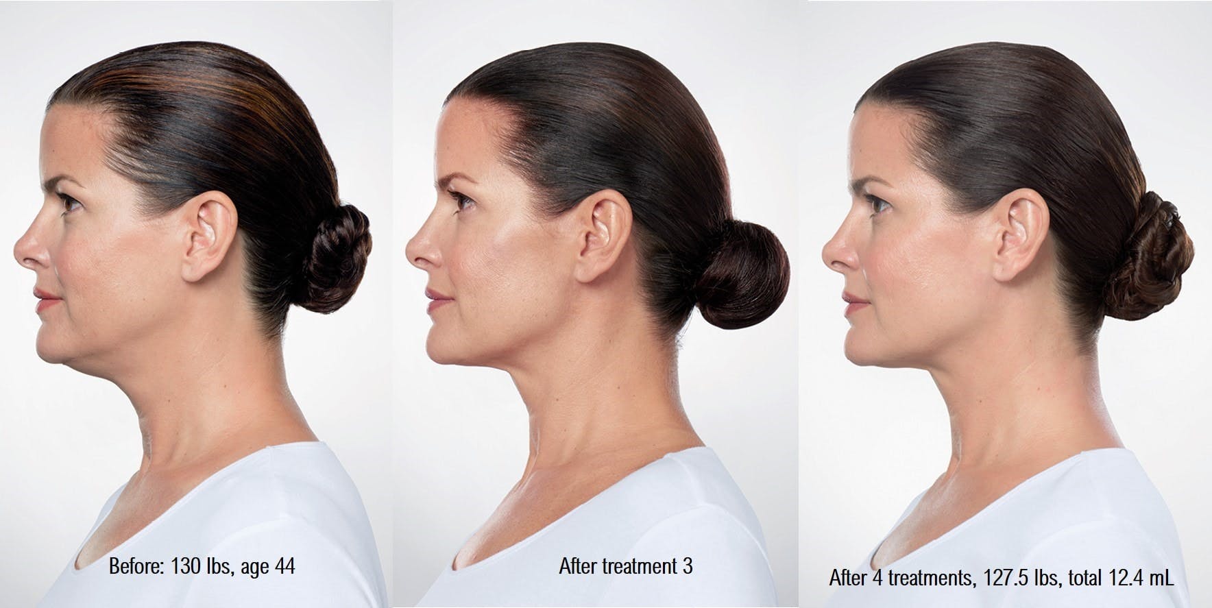 Kybella Before & After Gallery - Patient 58178644 - Image 1