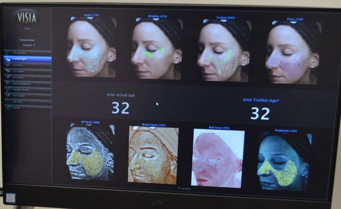 What Is a VISIA Skin Analysis? The Secret Weapon of Our Complimentary