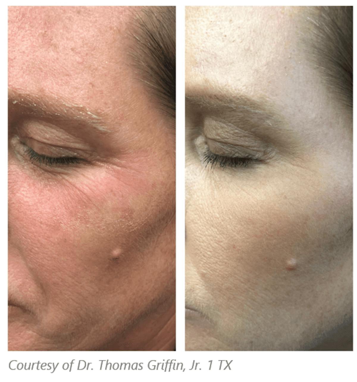 Subnovii Plasma Pen Before & After Gallery - Patient 60803972 - Image 1